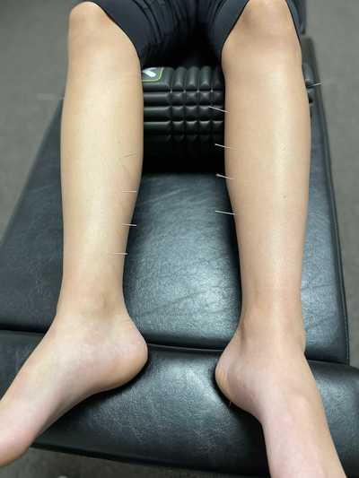 Dr. Carter at InMotion chiropractic Buffalo Minnesota performing acupuncture for leg pain